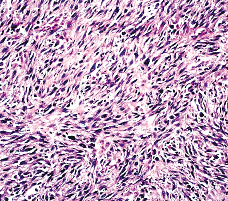 Pathology Outlines Undifferentiated Pleomorphic Sarcoma